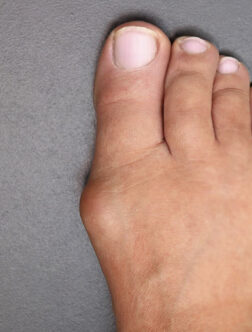 P&eacute;če při vbočen&eacute;m palci 7