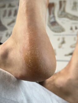 P&eacute;če o suchou a loupaj&iacute;c&iacute; se kůži na chodidlech 8