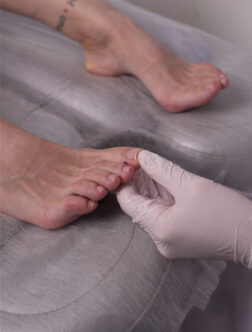 O&scaron;etřen&iacute; zarostl&eacute;ho nehtu 4