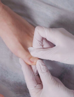 O&scaron;etřen&iacute; pl&iacute;sně nehtu (onychomyk&oacute;za) 3