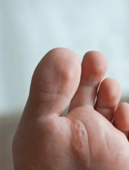 O&scaron;etřen&iacute; kuř&iacute;ho oka 2