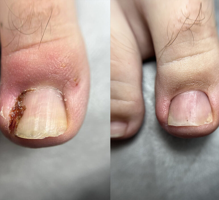 Step by step to relief - nail treatment with the correction system 2