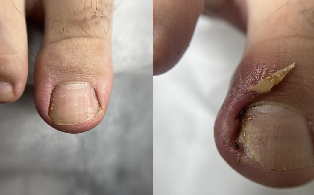 Úleva už první den – korekce nehtu přinesla výsledek okamžitě 1
