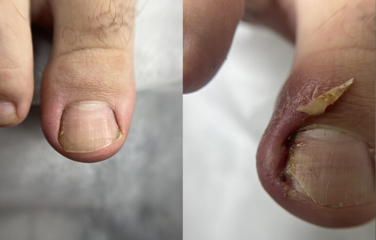 Relief already on the first day - the nail correction brought the result immediately 1
