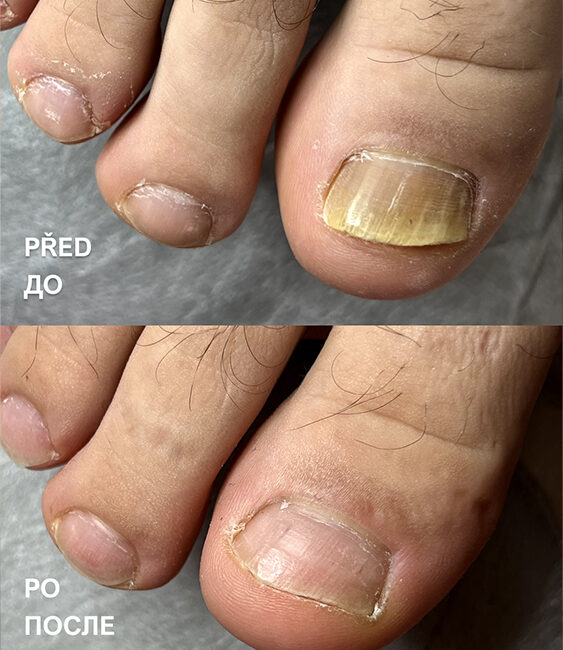Spolupráce podologa a dermatologa přinesla výsledek za 5 měsíců 1