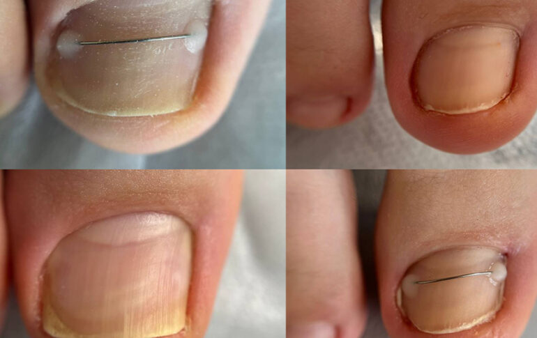 Correction of a severely deformed nail using a nail brace 8