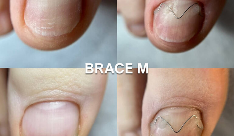 Ingrown and deformed nail due to pressure and improper care 7