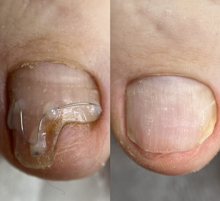Solution of ingrown nail in 2 months 5
