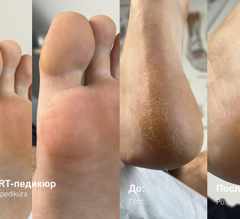 Kart pedicure - relief for dry and cracked skin 4